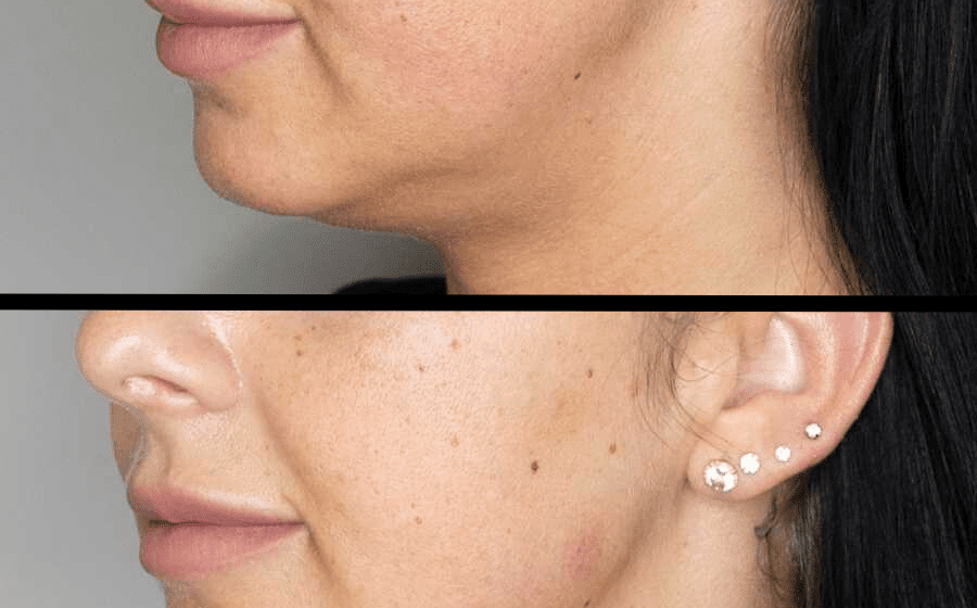 Dermal Fillers for Jawline