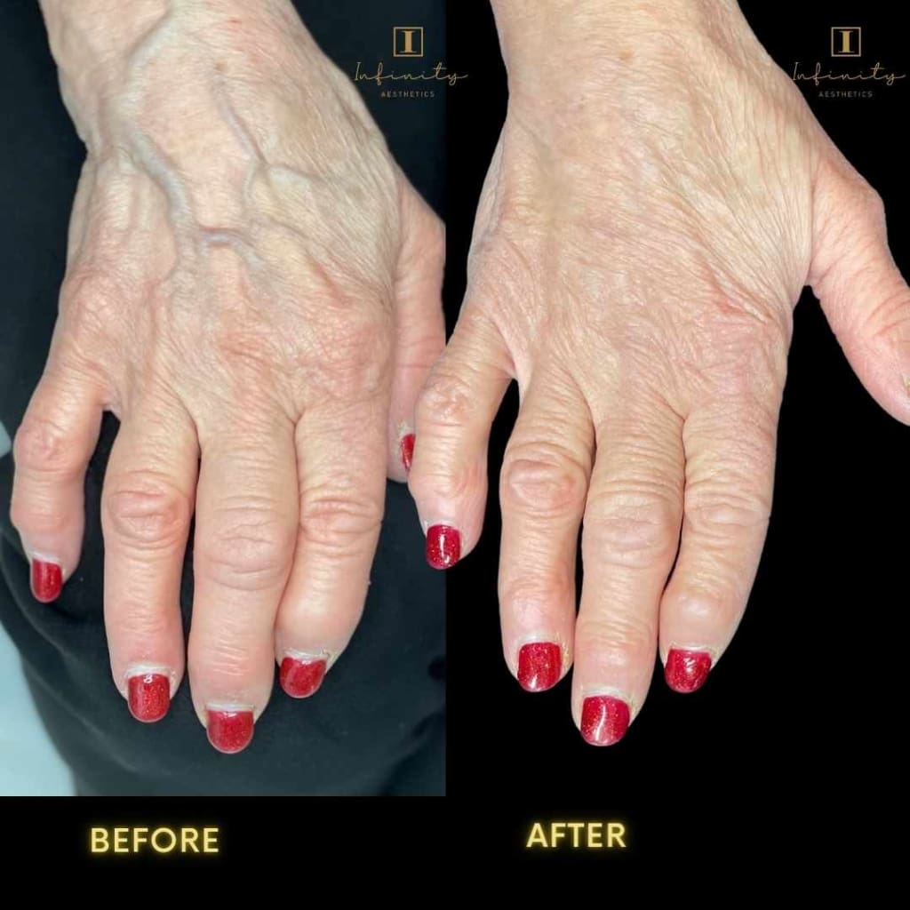 Hand dermal filler treatment with Radiesse in London
