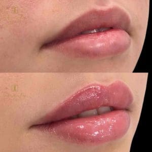 Beautiful lips dermal filler