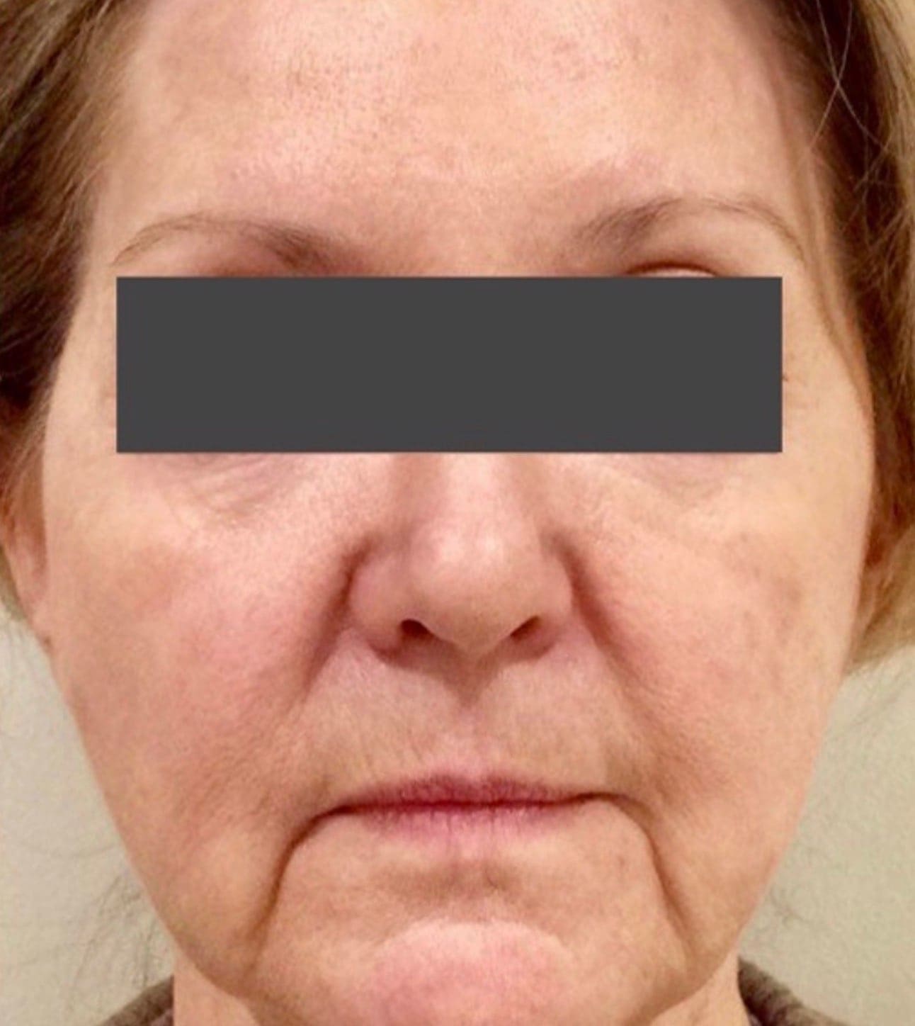Lady before marionette line treatment with dermal filler