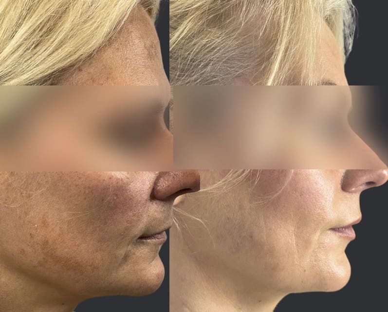 Lady before and after Morpheus 8