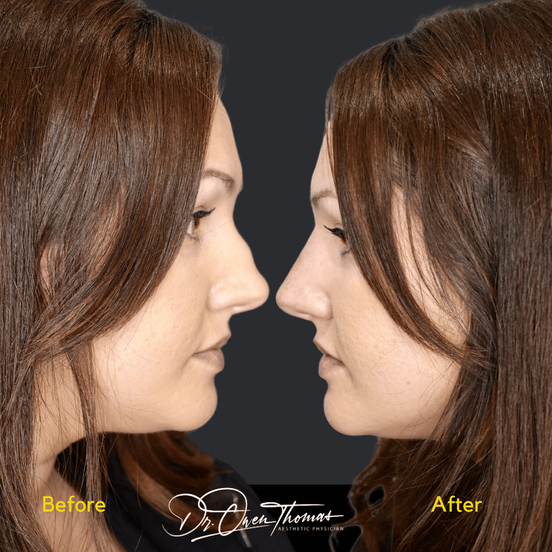 Non-surgical rhinoplasty case done by Dr Owen Thomas in London