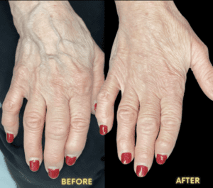Hand rejuvenation with dermal fillers and Radiess in London
