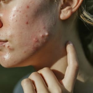 person_with_acne